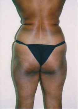 Liposuction