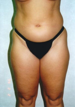 Liposuction