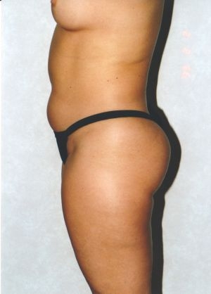 Liposuction