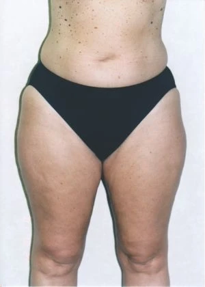 Liposuction