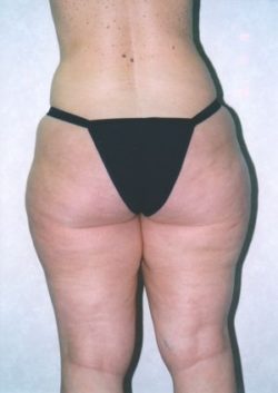 Liposuction