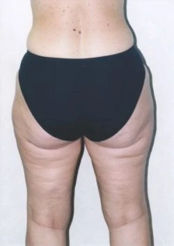 Liposuction