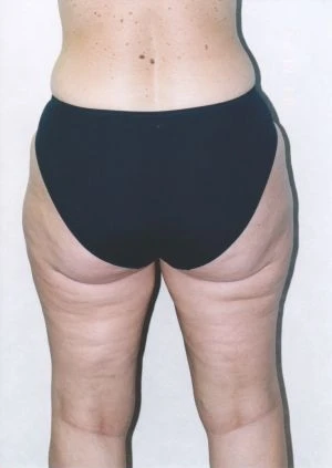 Liposuction