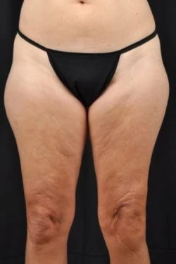Liposuction