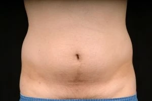 Liposuction