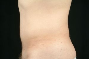 Liposuction