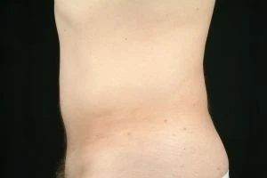 Liposuction