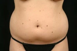 Liposuction