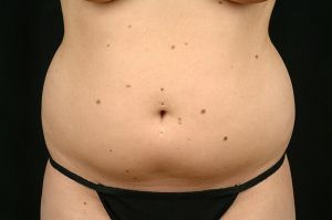 Liposuction