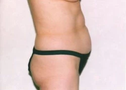 Liposuction
