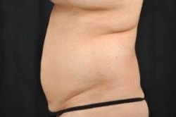 Liposuction