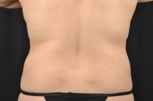 Liposuction