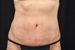 Liposuction