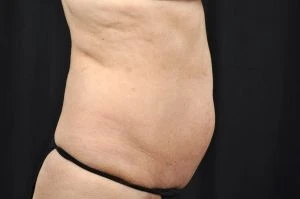 Liposuction