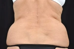 Liposuction