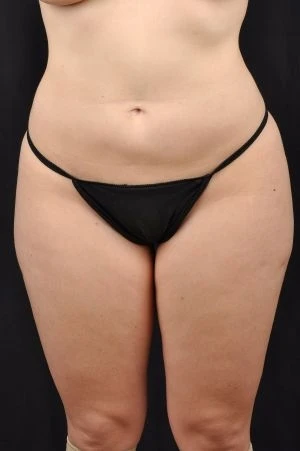 Liposuction