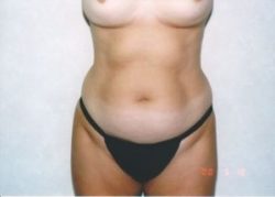 Liposuction