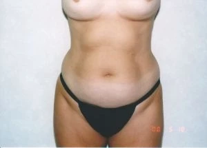 Liposuction
