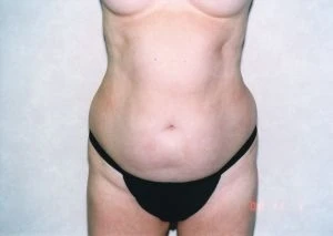 Liposuction