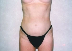 Liposuction