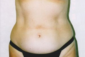 Tummy Tuck