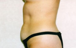 Tummy Tuck