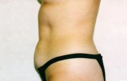 Tummy Tuck