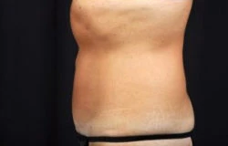 Tummy Tuck