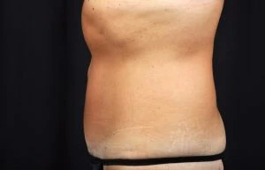 Tummy Tuck