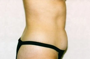 Tummy Tuck