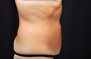Tummy Tuck