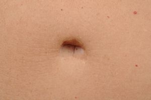 Tummy Tuck
