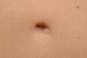 Tummy Tuck