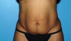 Tummy Tuck