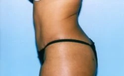 Tummy Tuck