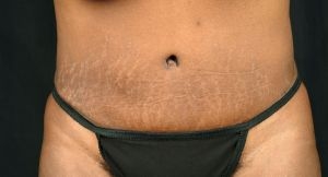 Tummy Tuck