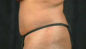 Tummy Tuck