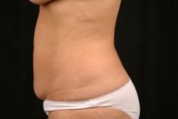 Tummy Tuck