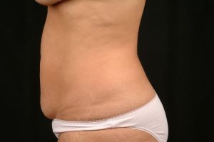Tummy Tuck