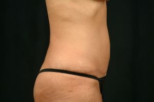 Tummy Tuck