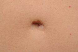 Tummy Tuck