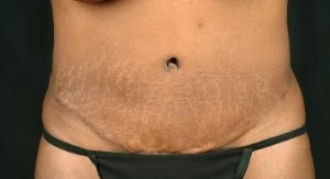 Tummy Tuck