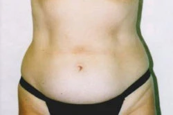 Tummy Tuck
