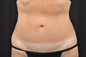 Tummy Tuck