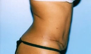Tummy Tuck