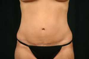 Tummy Tuck