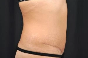 Tummy Tuck