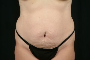Tummy Tuck