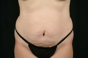 Tummy Tuck