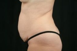 Tummy Tuck
